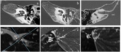 Value of Preoperative Imaging Results in Predicting Cochlear <mark class="highlighted">Nerve Function</mark> in Children Diagnosed With Cochlear Nerve Aplasia Based on Imaging Results